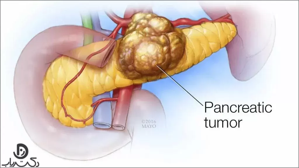تشخیص سرطان پانکراس چگونه انجام می شود؟