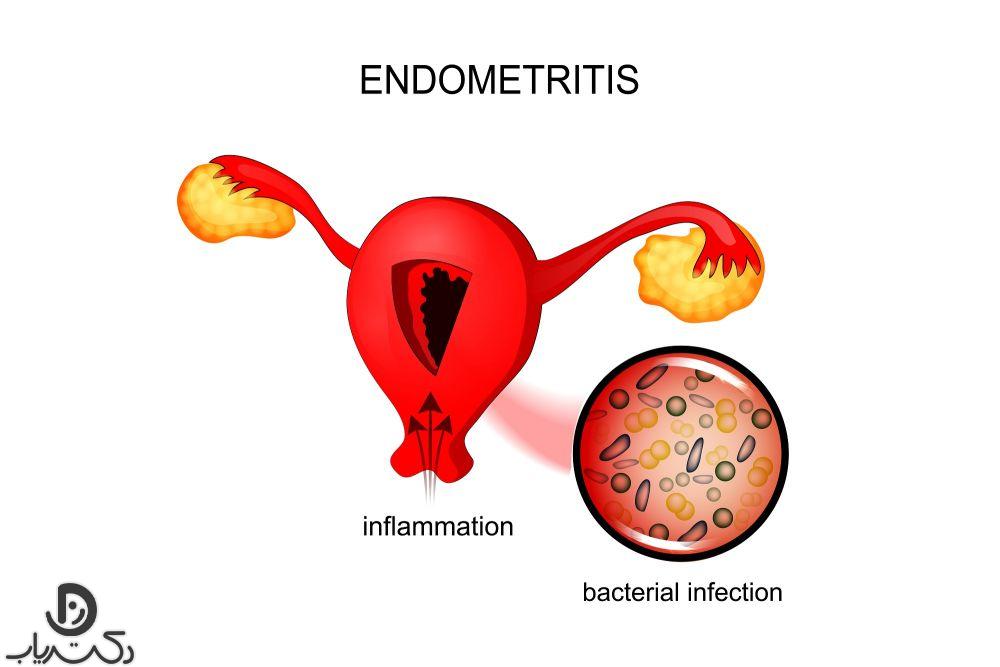 بیماری التهابی لگن و عفونت رحمی