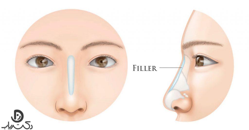 فیلر بینی چیست؟