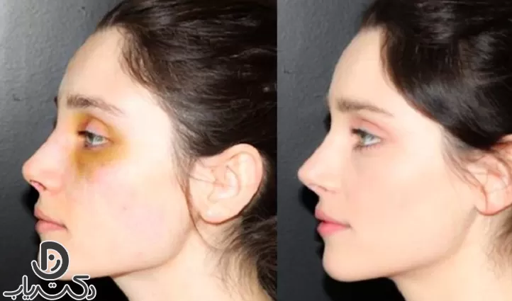 Bruise after rhinoplasty