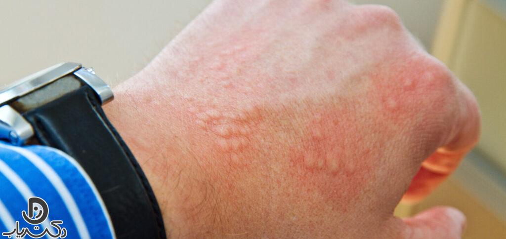 Contact dermatitis