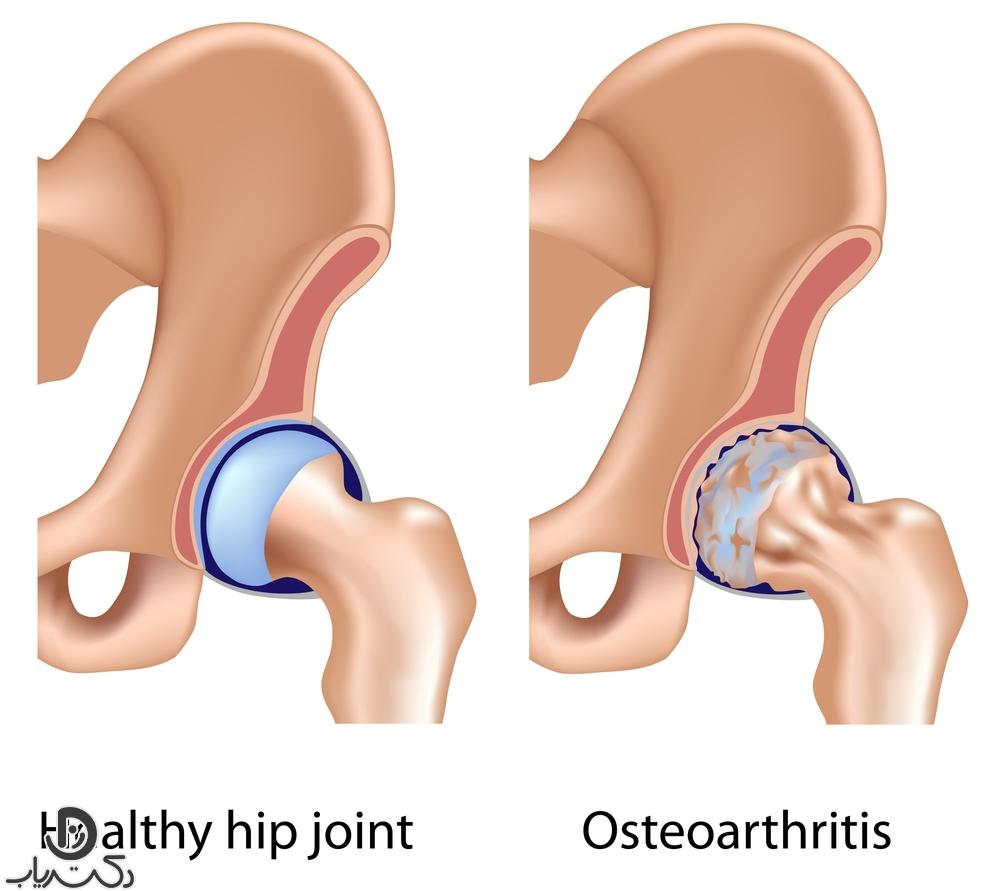 Degenerative or mechanical arthritis osteoarthritis