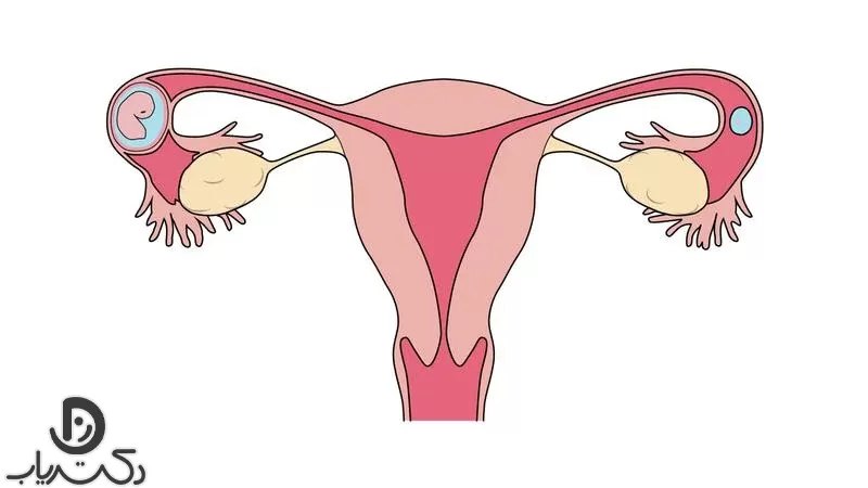 درمان بارداری خارج از رحم چیست؟
