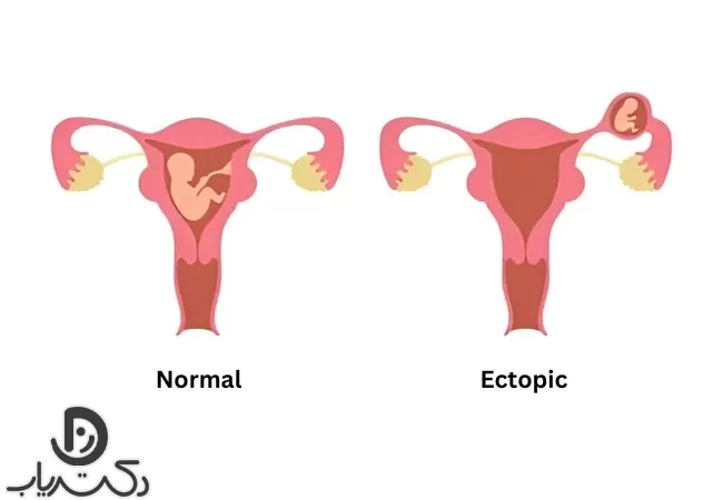 علائم حاملگی خارج از رحم چیست؟