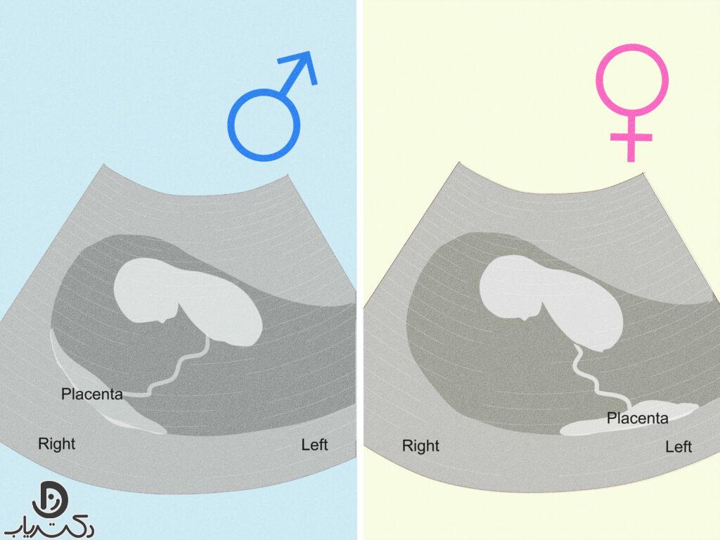 Gender determination before pregnancy