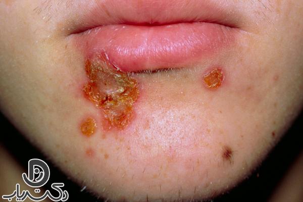 Impetigo