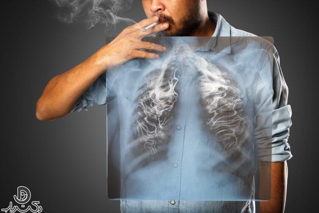 Lung cancer in men