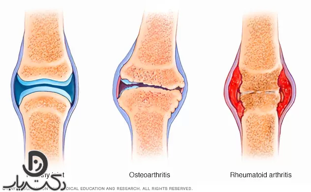 Osteoarthritis