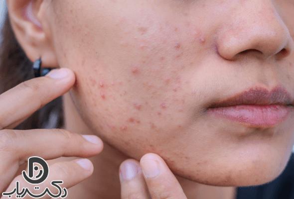 Red spots on the skin of the face