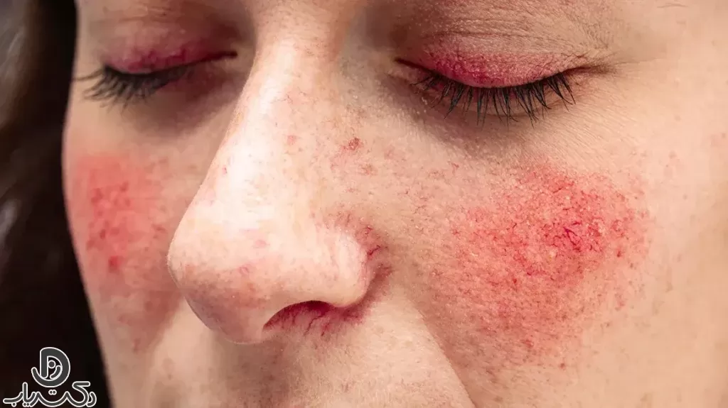 Rosacea