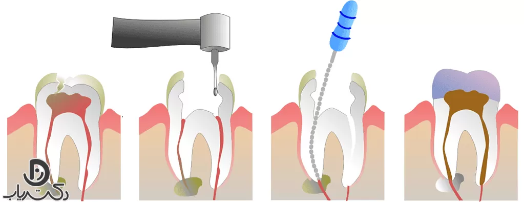 به چه منظور درمان کانال ریشه صورت می­گیرد؟