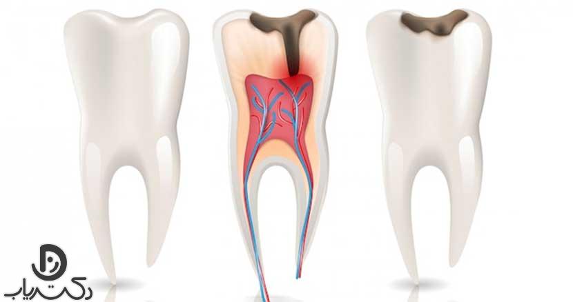 Tooth denervation4