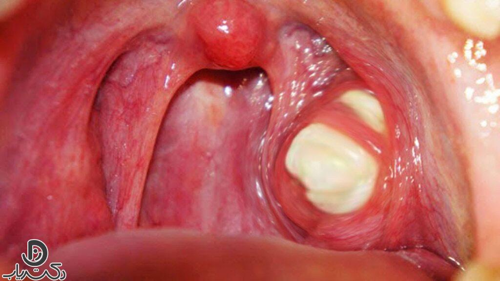 Treatment of tonsil stones