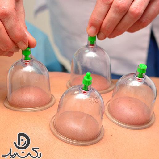 cupping