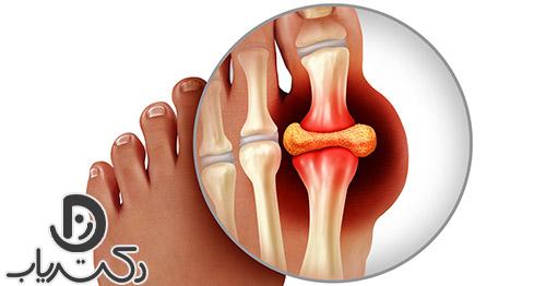 نقرس چیست ؟ نحوه تشخیص و درمان آن