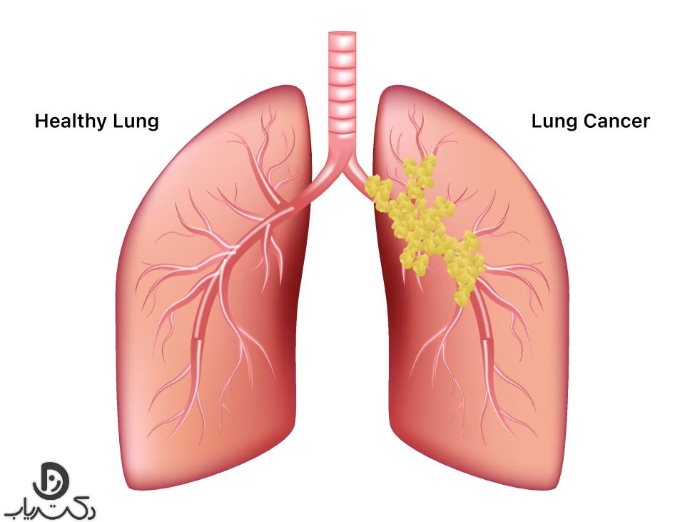 سرطان ریه چیست؟