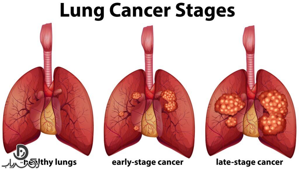  انواع سرطان ریه: