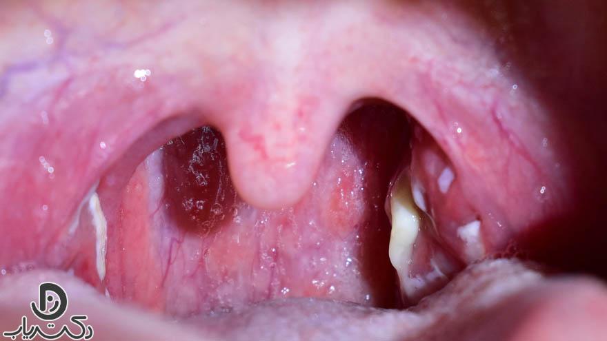 tonsil cancer