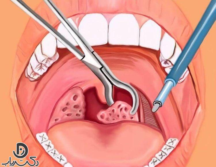 tonsil removal