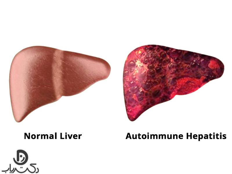 Autoimmune hepatitis