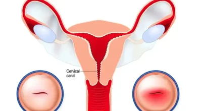 زخم دهانه رحم : علل، علائم و شیوه های درمان آن
