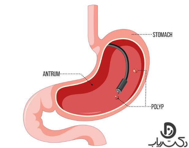 Diagnosis of stomach cancer