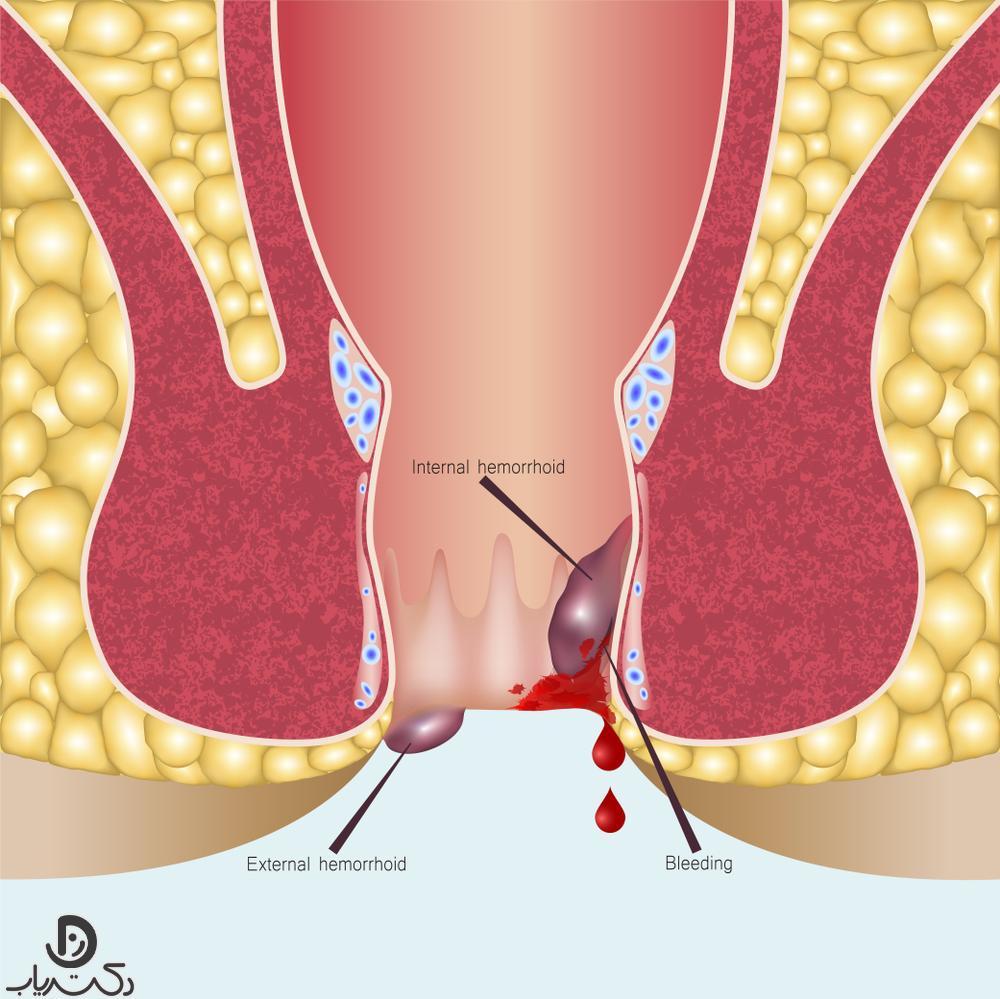 Rectal bleeding due to esophageal disease