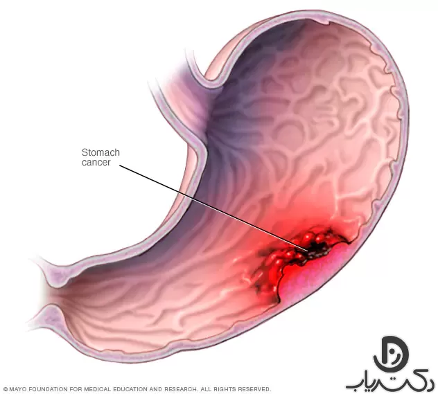 از کجا بفهمیم سرطان معده داریم؟