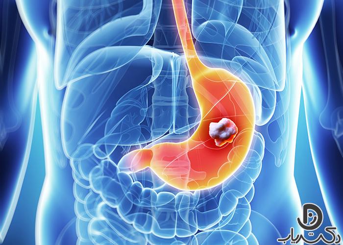 سرطان معده چیست و آیا امکان درمان وجود دارد؟