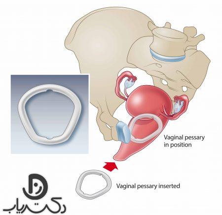 Surgical treatment of uterine prolapse