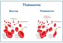 بیماری تالاسمی چیست ؟ علل، علائم و روش درمان آن