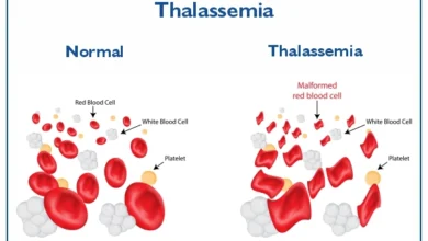 بیماری تالاسمی چیست ؟ علل، علائم و روش درمان آن