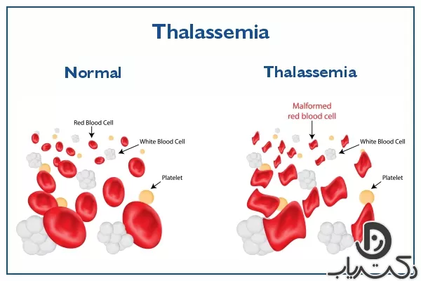 بیماری تالاسمی چیست ؟ علل، علائم و روش درمان آن