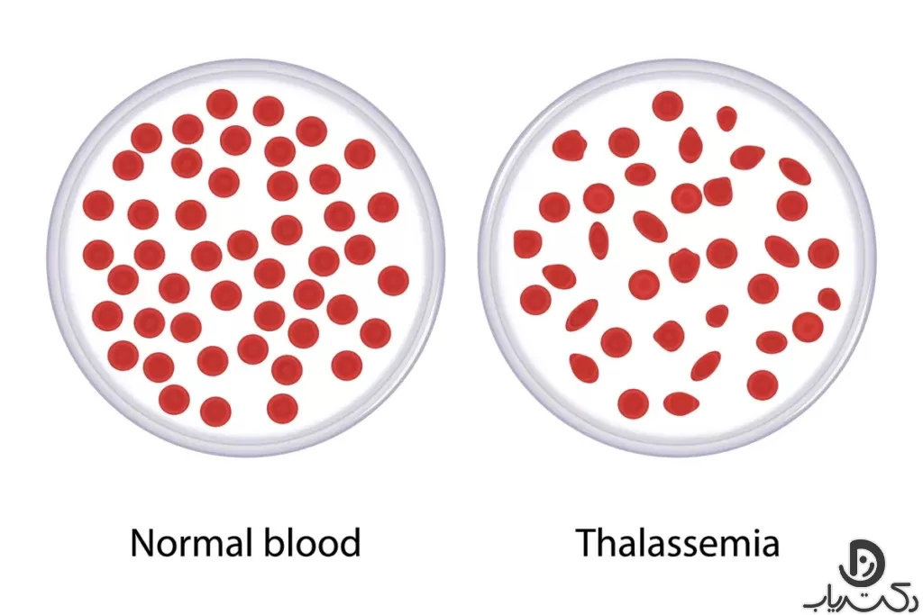 انواع تالاسمی