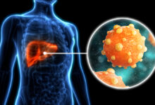 هپاتیت چیست و چگونه بر بدن تأثیر می‌گذارد؟
