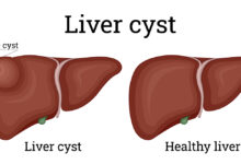 علائم کیست کبدی