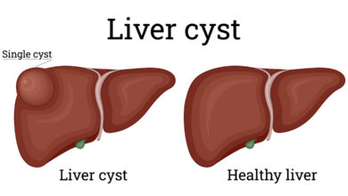 علائم کیست کبدی