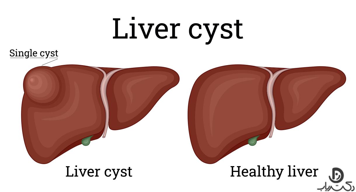 علائم کیست کبدی