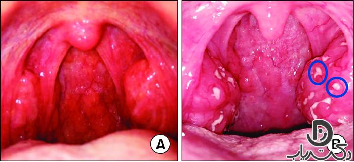 pharyngitis4