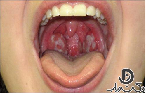 pharyngitis5