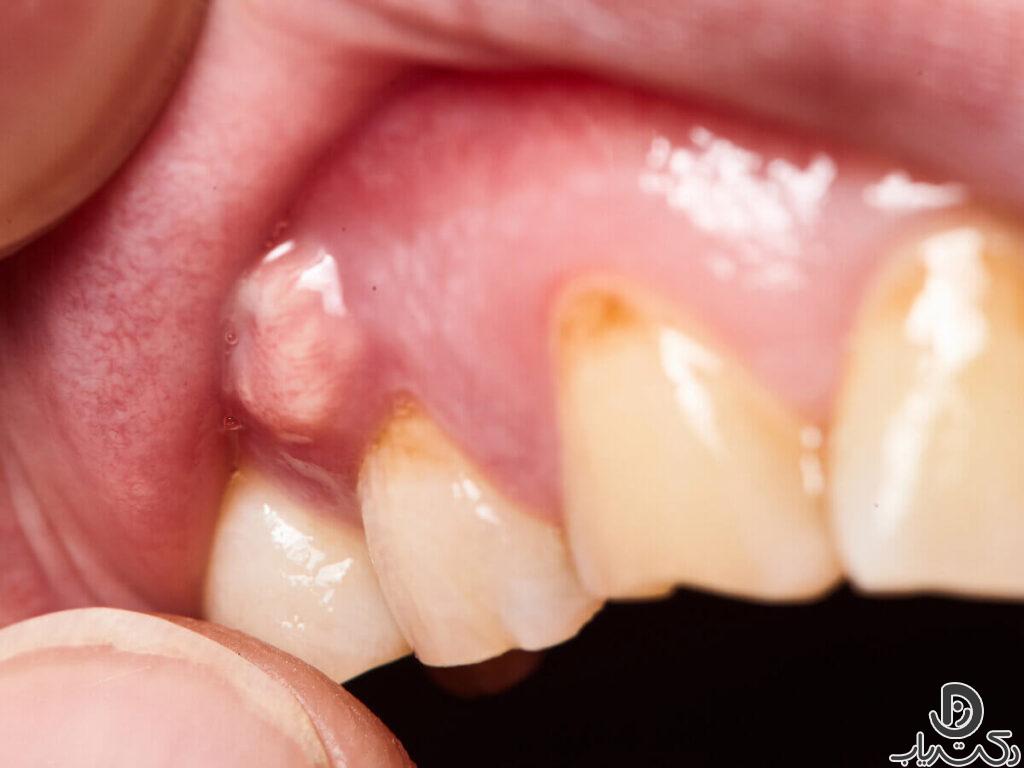 tooth abscess10