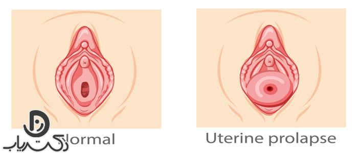 افتادگی رحم چیست؟ علل، علائم و روش‌های درمان آن