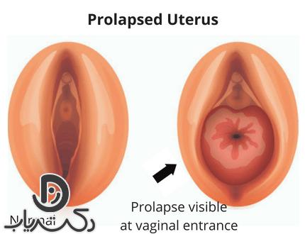 آیا بیماری‌های دیگری هم باعث افتادگی رحم می‌شوند؟