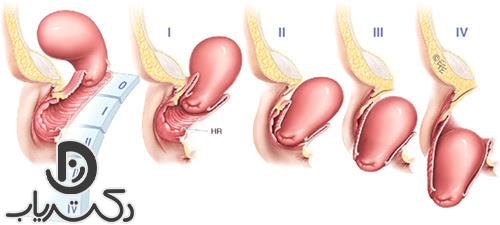 علائم افتادگی رحم چیست؟
