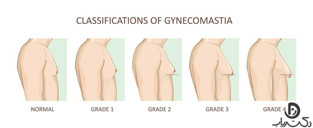 Gynecomastia2