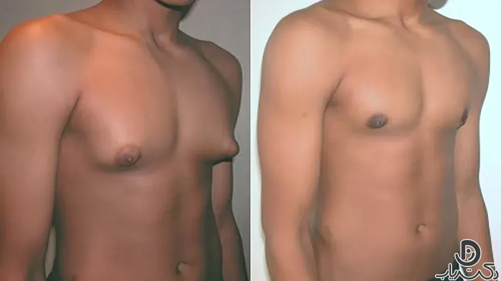 Gynecomastia3