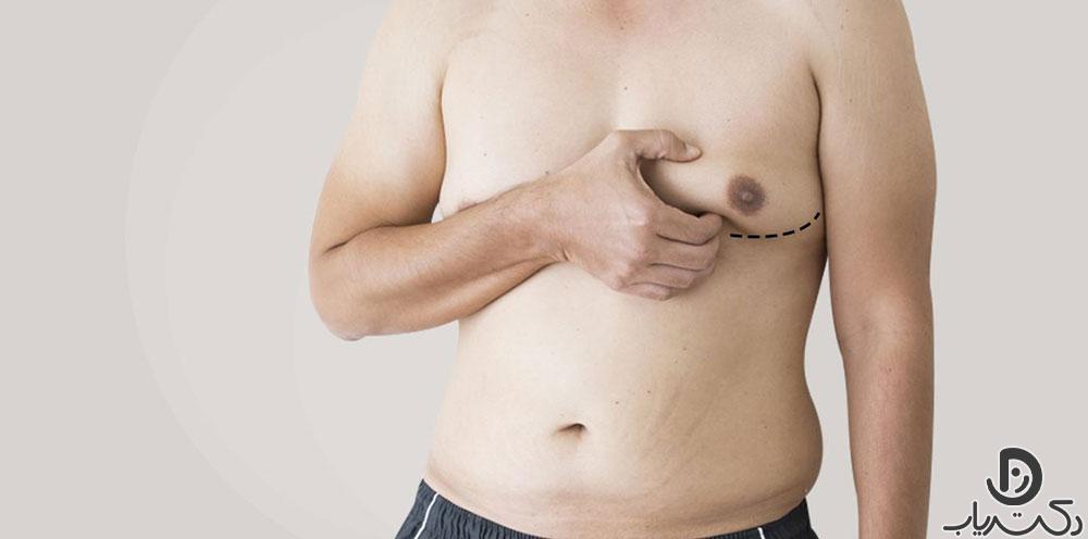 Gynecomastia4