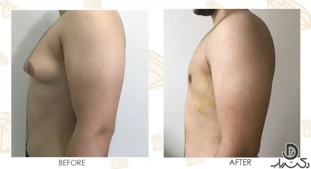 Gynecomastia5