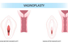 جراحی واژینوپلاستی چیست؟ مزایا و عوارض آن