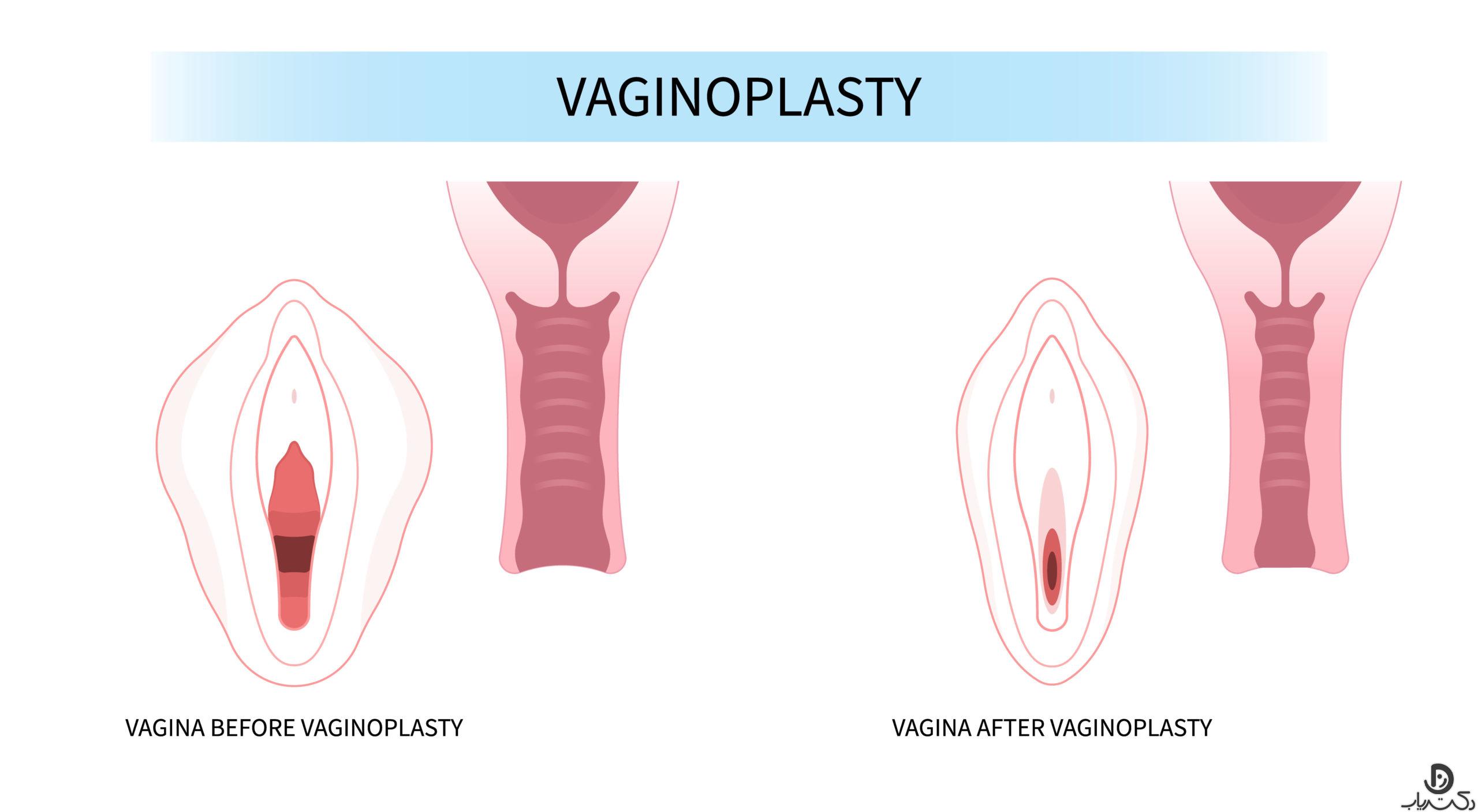 جراحی واژینوپلاستی چیست؟ مزایا و عوارض آن